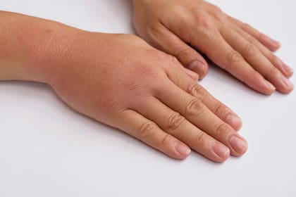 Las altas temperaturas causan dilatación en los vasos sanguíneos y la sangre fluye más lentamente