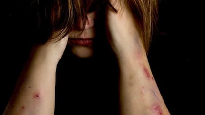 Las autolesiones son frecuentes en personas con problemas de salud mental que no encuentran una forma de exteriorizar sus emociones