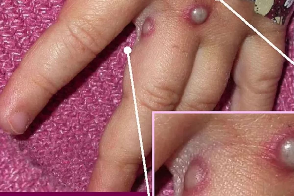 Las autoridades piden a la población estar alerta de los síntomas clásicos de la viruela del mono para controlar cuanto antes los brotes