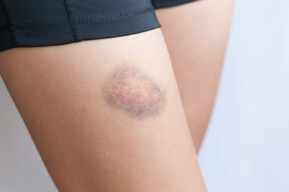 Las causas por las que salen los hematomas en la piel