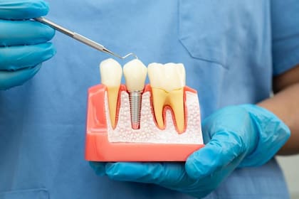 Las coronas dentales no solo son costosas, sino que no están exentas del riesgo de producir infecciones