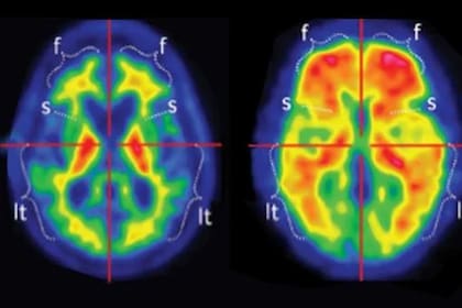 Las devastadoras revelaciones que dejó el escáner cerebral del paciente más joven con Alzheimer