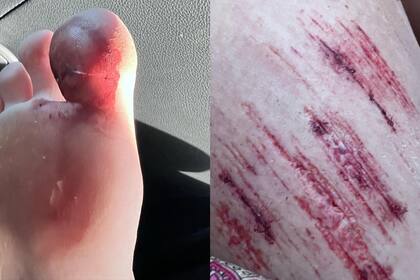 Las dolorosas lastimaduras que se hizo la China Suárez