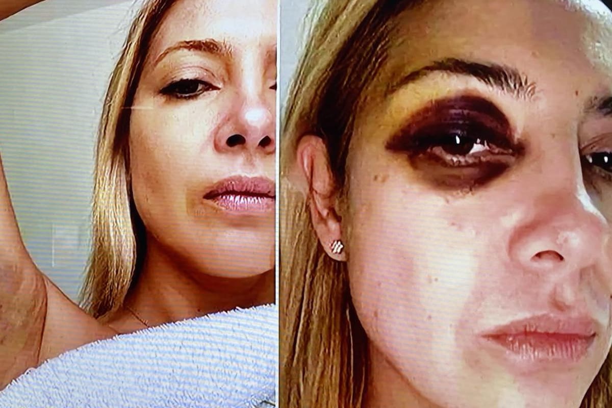 Las dos fotografías exhiben a Yañez con moretones en el ojo derecho, a la altura del pómulo y en la axila derecha