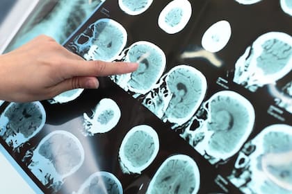 Las enfermedades cardiovasculares se vinculan al corazón y los vasos sanguíneos