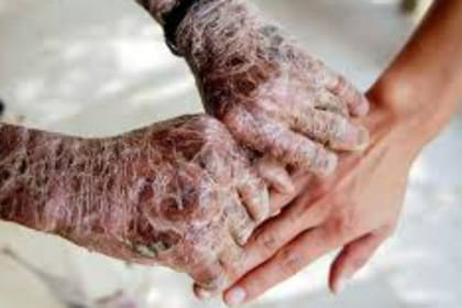 Las Enfermedades Poco Frecuentes (EPOF) son más de 7000, según estima la OMS