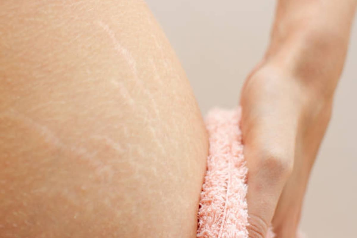 Las estrías pueden aparecen en cualquier etapa de la vida; existen varias formas de tratarlas (Foto Pexels)