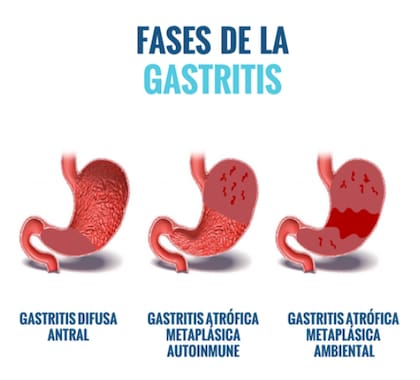 Las fases de la gastritis
