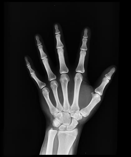 Las fracturas en la muñeca son uno de los primeros signos que presenta la osteoporosis en el cuerpo (imagen ilustrativa)