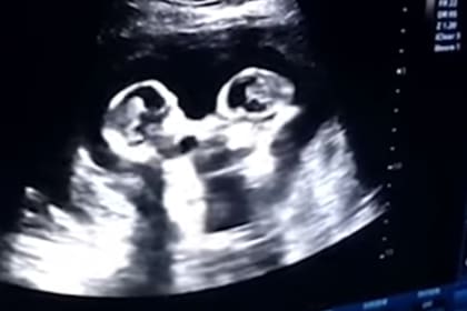 Las gemelas pelean en el útero de la madre (según parece en la ecografía)