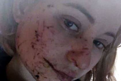 Las heridas de Tania estaban claramente visibles cuando tomó esta foto dos días después del bombardeo.