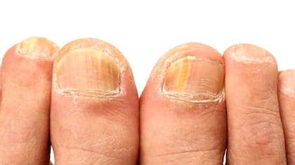 Las infecciones causadas por hongos pueden dejar las uñas descoloridas, amarillenta, engrosada o distorsionadas