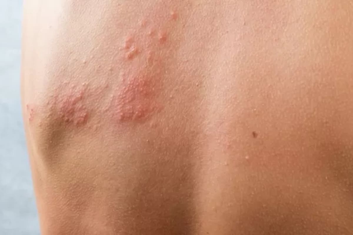 Las lesiones características del herpes zóster
