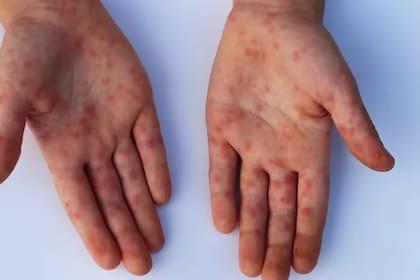 Las lesiones en la piel características de la viruela símica