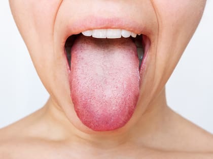 Las lesiones o molestias en la lengua pueden obedecer a enfermedades locales o pueden ser manifestación de enfermedades sistémicas