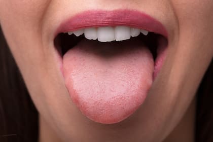 Las lesiones o molestias en la lengua pueden obedecer a enfermedades locales o pueden ser manifestación de enfermedades sistémicas