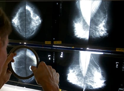 Las mamografías continúan siendo una recomendación