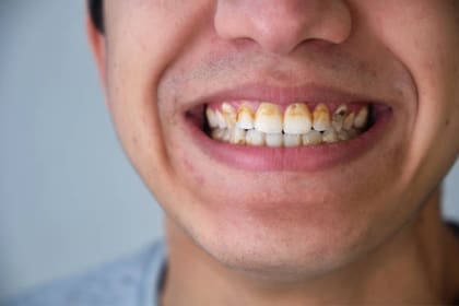 Las manchas amarillas o negras en la línea gingival indican la presencia de depósitos rígidos