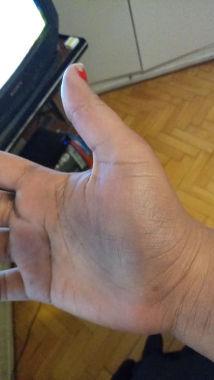 Las marcas de los golpes brutales que recibió una joven a la que le robaron la bicicleta, una riñonera y el celular cuando pasaba frente a la villa Fraga, en Chacarita.