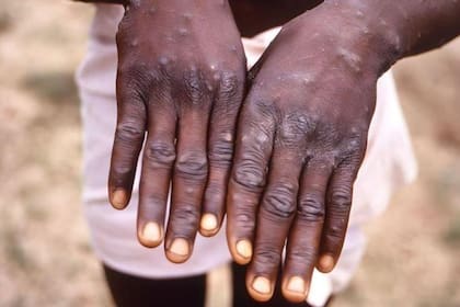 Las marcas en la piel características de la enfermedad