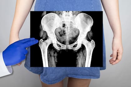 Las personas con alto riesgo de osteoporosis también incluyen aquellas con diabetes tipo 1 y tipo 2