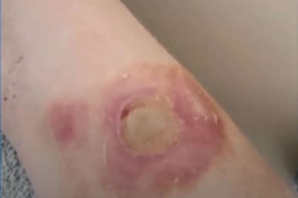 Las quemaduras autoprovocadas pueden ser hasta de segundo grado