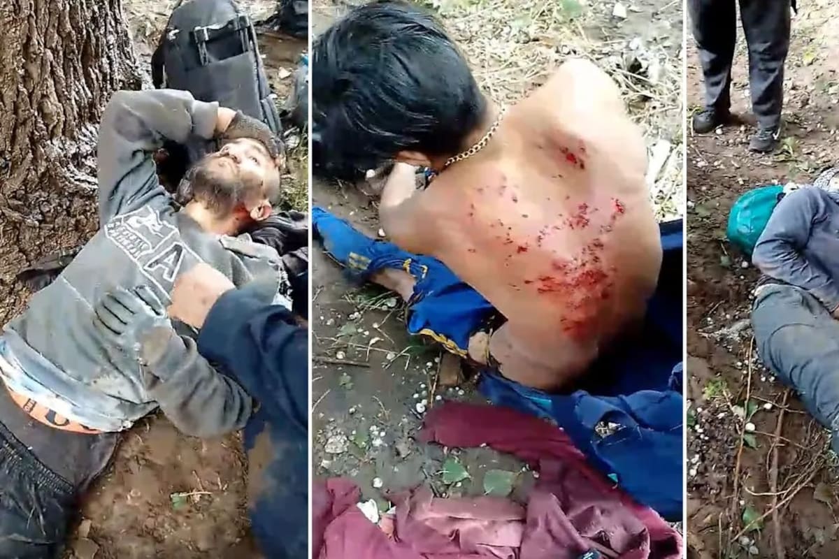 Las quemaduras en los cuerpos de los cosechadores del ajo, tras ser alcanzados por la descarga eléctrica del rayo.