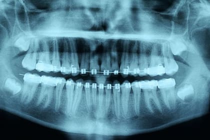 Las radiografías son clave para conocer si una boca está sana y es capaz de soportar el uso de frenillos y alineadores.