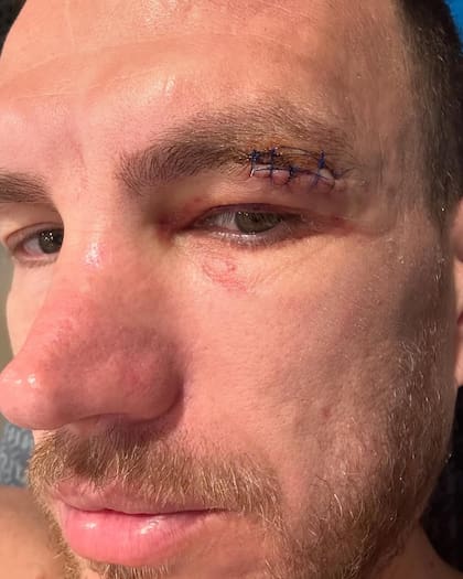 Las secuelas de la lesión de Edin Dzeko