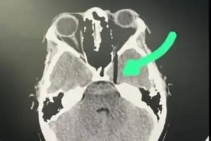Le empujaron la cara contra su torta de cumpleaños y casi pierde el ojo; la tomografía mostró el palo clavado