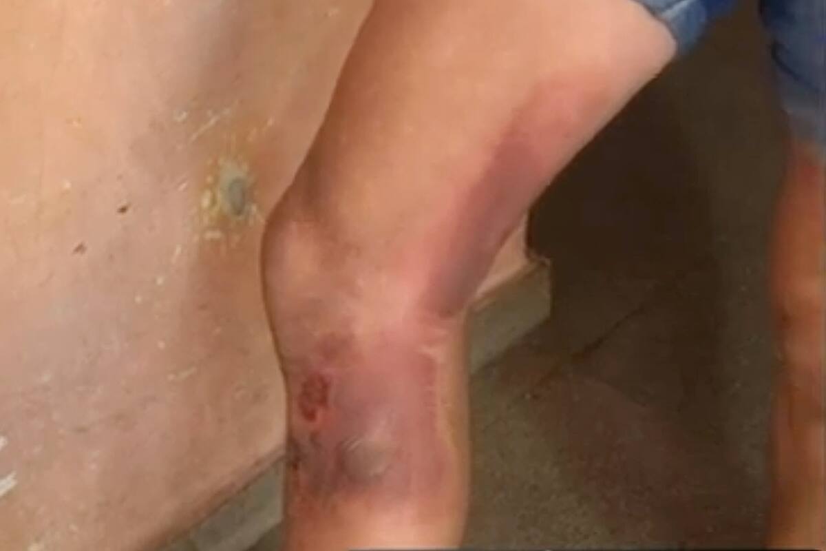 Le exploto el celular mientras dormía