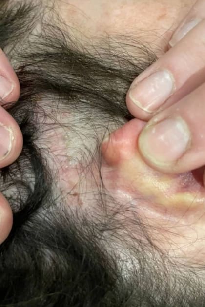 Lee King se quitó el nevus azul en una serie de tres intervenciones quirúrgicas