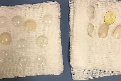 Un total de 27 lentes de contacto fueron encontrados en el ojo de una paciente británica de 67 años