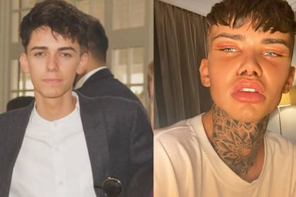 Levi Jed Murphy, de 24 años, oriundo de Manchester, Inglaterra, gastó 41.600 dólares en cirugías para parecerse a un filtro de Instagram