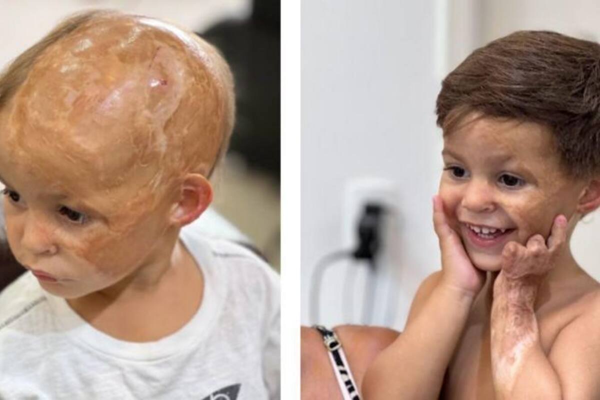 Lorenzo, uno de los niños que recibió una prótesis capilar.