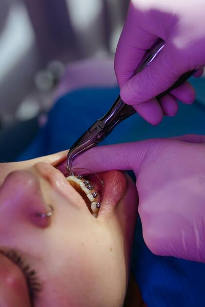 Los brackets tradicionales son una opción efectiva para mover los dientes mediante una fuerza gradual