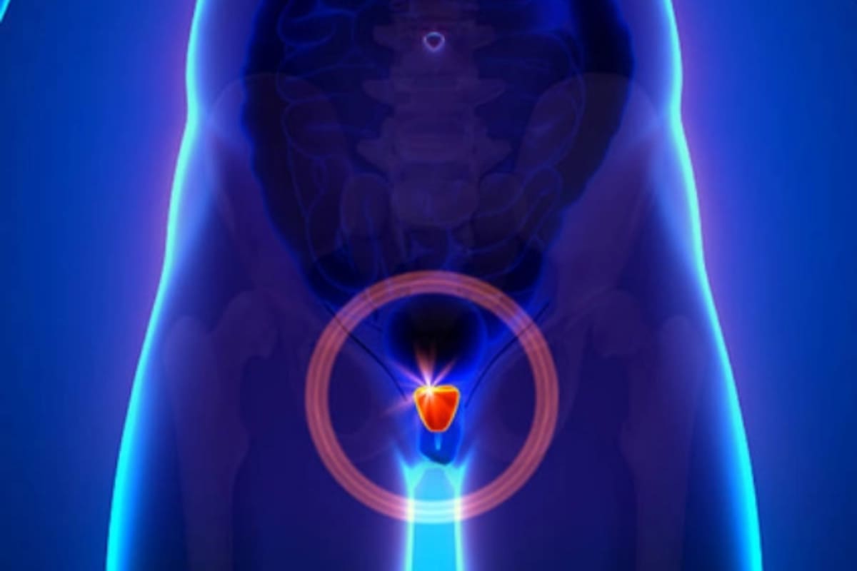 Los chequeos tempranos son clave para detectar el cáncer de próstata