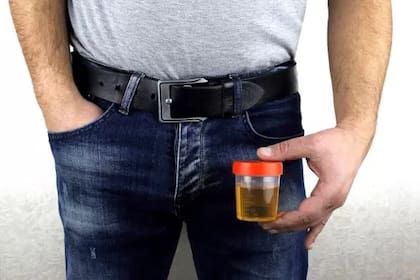 Los científicos han identificado varias bacterias en muestras de orina de hombres que desarrollaron cáncer de próstata agresivo.