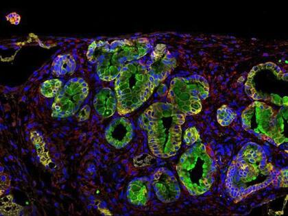 Los científicos reconocen que los tumores son tejidos complejos formados por células cancerosas y células normales que fueron reclutadas para apoyar su crecimiento