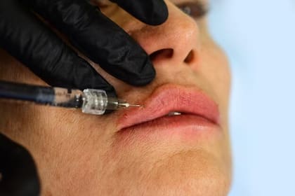 Los cirujanos plásticos dicen que cada vez más pacientes menores de 30 años solicitan rellenos labiales y otros procedimientos estéticos