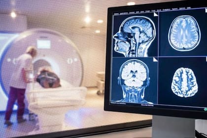 Los científicos desconocen las causas exactas de la niebla mental; según las principales teorías, el cuadro podría presentarse cuando la respuesta inmunológica del cuerpo no se apaga una vez superado el coronavirus