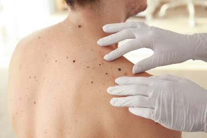 Los especialistas destacan que la clave es la detección temprana del melanoma