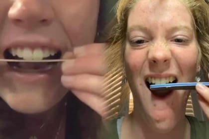 Los especialistas en odontología advierten sobre una peligrosa tendencia que se popularizó entre usuarios de TikTok para cambiar la forma de los dientes