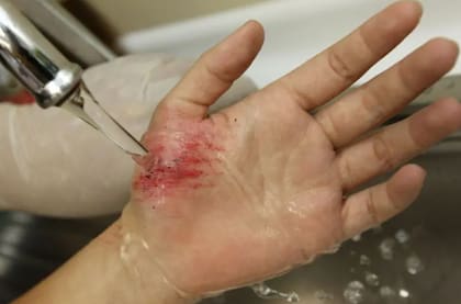 Los expertos afirman que, para los raspones comunes, la mejor solución es agua y jabón