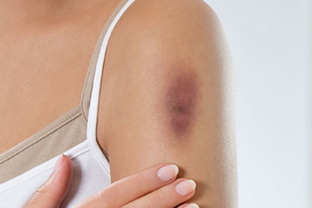 Los hematomas generan ardor y dolor en la piel (Imagen ilustrativa)