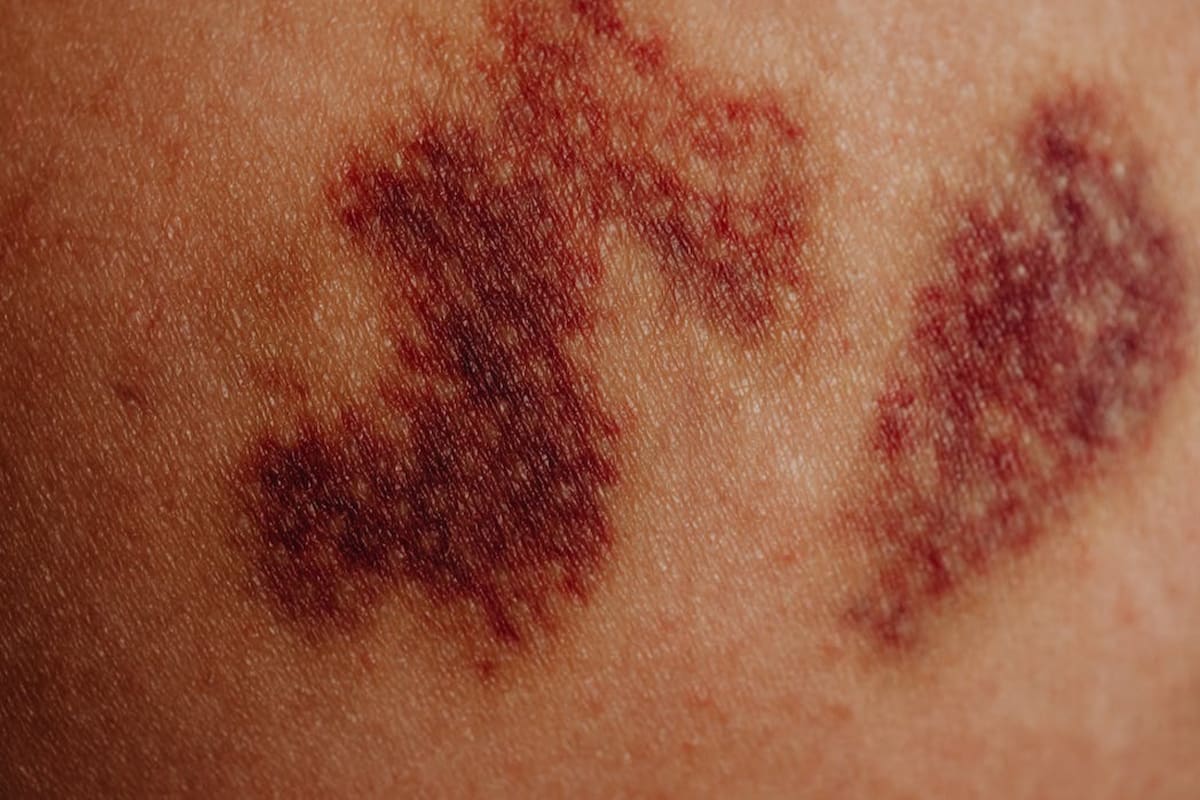 Los hematomas pueden aparecer por la deficiencia de una vitamina (Foto Pexels)