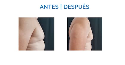 Los hombres tienen un mayor riesgo de sufrir HAP después de un tratamiento de criolipólisis