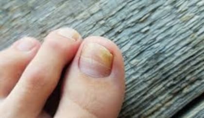 Los hongos de las uñas de los pies son un problema común que afecta a millones de personas en el mundo