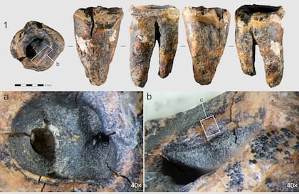 Los investigadores concluyeron que el neandertal sobrevivió a la intervención y siguió utilizando su diente