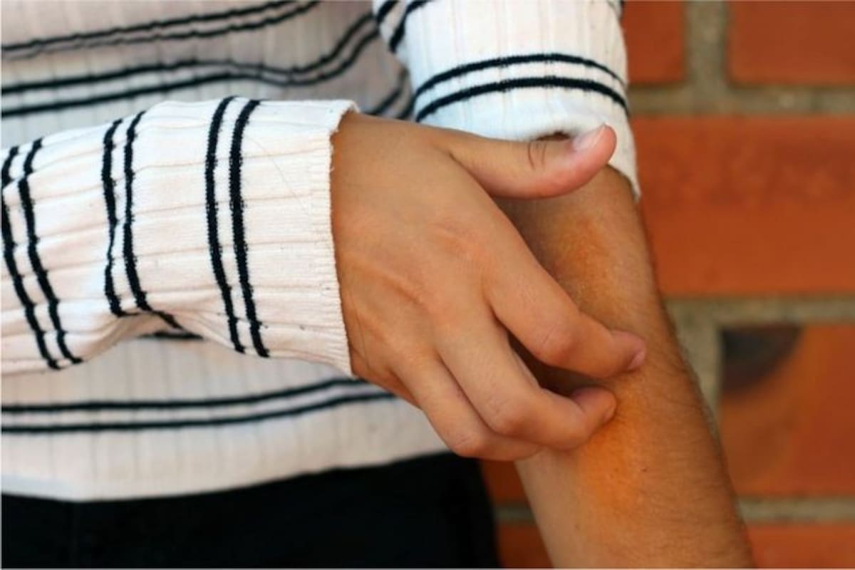 Los investigadores dividieron los efectos que describieron los pacientes en dos grandes grupos: erupciones y erupciones inflamatorias, por una parte, y lesiones vasculopáticas, por otra.